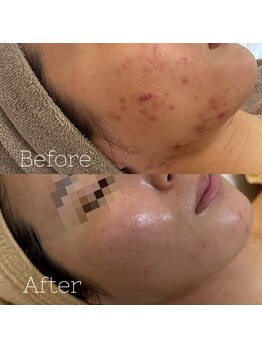 アテ 国分寺店(Ate)/繰り返さないニキビケア