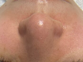 ビューティフィール アンド アリサナ(Beauty Feel&Arisana)の写真/エクストラクションでお肌の調子を整え、毛穴の汚れを徹底オフ☆毛穴の黒ずみや角栓も除去しツルツル肌に☆