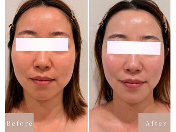ビビラフィネ(BiBi Raffine)の写真/【たるみ・むくみ・二重あごに◎】ラジオ波 × 小顔ケアで年齢とともに気になる頬・輪郭のもたつきを解消♪