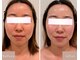 ビビラフィネ(BiBi Raffine)の写真/【たるみ・むくみ・二重あごに◎】ラジオ波 × 小顔ケアで年齢とともに気になる頬・輪郭のもたつきを解消♪