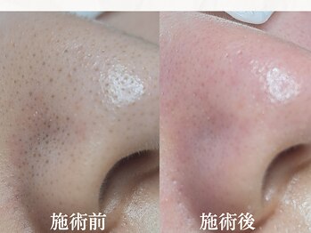 エレヌイ(ELENUI)/毛穴黒ずみ☆詰まり改善