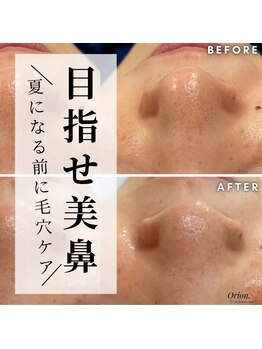 オリオンドットエスツー(Orion.S2)/【Before→After】