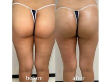 エピジュ(Epijyu)/むくみやセル脂肪撃退マッサージ