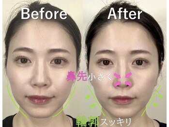 ラプリアンジュ 鹿児島天文館店(Raplit ange)/隆鼻矯正+輪郭矯正40分 1回