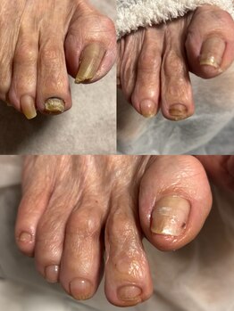 リゼラアンドコー 柏原店の写真/巻き爪や肥厚爪など、爪にお悩みのある方は一度リゼラ&コーへご相談ください♪