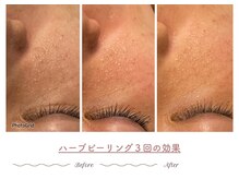 エステティックサロン シーズ/“育てる肌質改善”