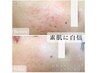 【真夏の肌管理☆】シミ改善/美白/毛穴改善に◎光フェイシャル[60分]