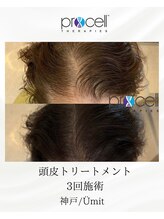 ユミト(Umit)/プロセルスカルプ