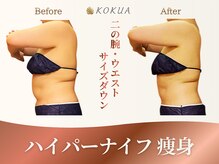痩身専門店エステティックサロン コクア(KOKUA)の雰囲気（【ハイパーナイフ】脂肪を徹底分解！）