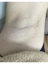 ナノハナ/鹿沼市全身脱毛美容室ナノハナ