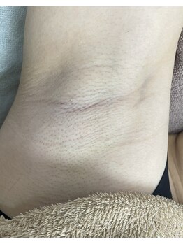 ナノハナ/鹿沼市全身脱毛美容室ナノハナ