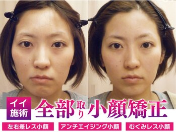 モアフェイス 池袋店(More Face)の写真/◆頬骨矯正＋脂肪矯正が大得意◆頭蓋骨から小顔に！施術に自信あり【ゆがみ矯正・リンパ矯正3980円~】