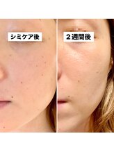 モイラ(MOIRA)/産後のシミ改善