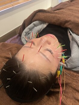 長寿鍼灸院 長寿整骨院/美容鍼50本の効果★