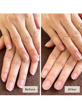 爪先トラブル改善