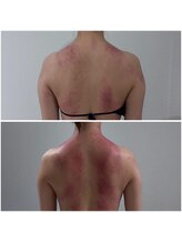 リブ シャルム(Lib Charm)/シークレシー背中1回施術