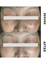 ゼロ 水戸店(ZERO)/シミ・シワ肌質改善スペシャル