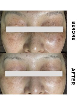 ゼロ 水戸店(ZERO)/シミ・シワ肌質改善スペシャル