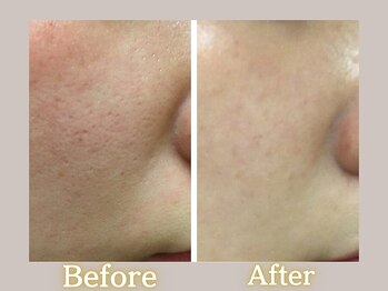 ハル(HARU.)/毛穴ハーブピーリング