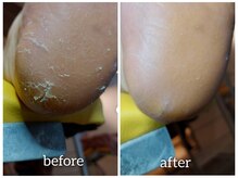 爪切り屋 足楽/【踵のひび割れ】