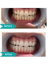 ティンクルホワイト 上尾店/ホワイトニングBefore After