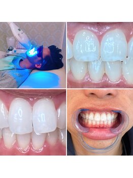 ニコ ホワイトニング 扶桑(Nico Whitening fuso)の写真/その黄ばみ、そのままにしますか?!【セルフホワイトニングお試し¥3500/しっかりトーンUP¥6600】完全個室◎