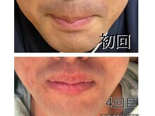 レイモード(Ray mode)/ヒゲ脱毛♪