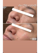 シス(SiS.)/ハーブピーリング