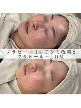 イロハ(IROHA)/プラピール×LDM