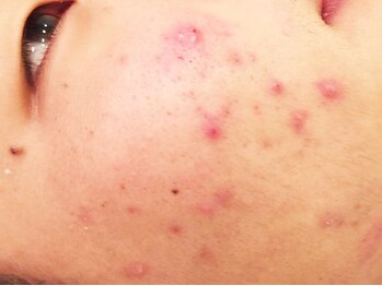 健美庵の写真/【ニキビケア/肌質改善】ニキビ/乾燥/毛穴/皮脂の肌トラブルケアに！美容鍼と首肩のマッサージで根本改善♪