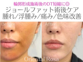 オリエンタルローザ 表参道(Oriental Rosa)/口横のポニョの術後ケア