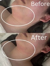 ミセル(MISEL2nd)/首のしわケアもお任せ★