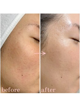 ミチル(mi-chill)/毛穴改善でふっくらツヤ肌♪