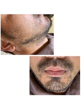 エステサロン桜/おヒゲを４～５日間伸ばした状態