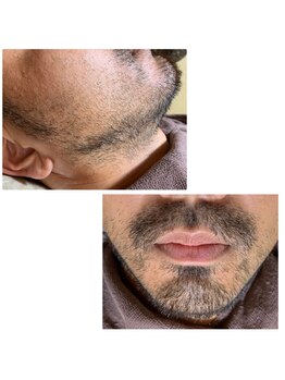 エステサロン桜/おヒゲを４～５日間伸ばした状態