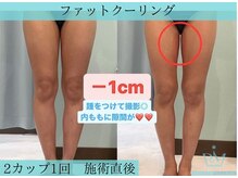リメイククリニカルビューティー(Remake clinical beauty)/【施術症例】脂肪冷却