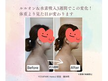 ヨサパーク ハヌル 住吉 錦糸町(YOSA PARK Haneul)/ルルオン＆水素吸入3週間の変化