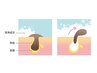 6月限定☆【毛穴汚れ&開き毛穴/ニキビケア】毛穴洗浄+光フェイシャル 