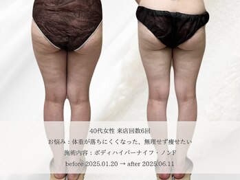 エメ(aimer)/BodyCare《痩身・代謝アップ》