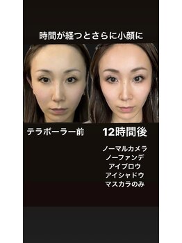 エクレクティック(ECLECTIC)/小顔/宇都宮エステ