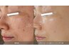 【DactorPeel】肌本来の美しさと内側から満たされた水光肌を引き出します60分