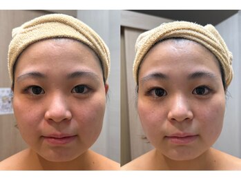 エステティック レイビス 池袋店(RAYVIS)/WINBACKフェイシャル