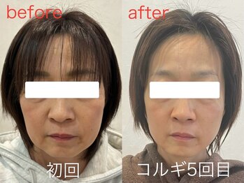 ビーキュート 学芸大学店(BE-CUTE)/Before/After 施術