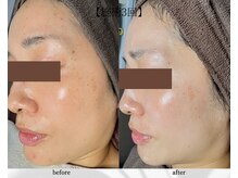 アン ビューティー(ann beauty)/施術3回【症例写真】30代