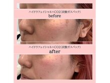 ディアメ(Diame)/毛穴汚れはサロンケアで＾＾