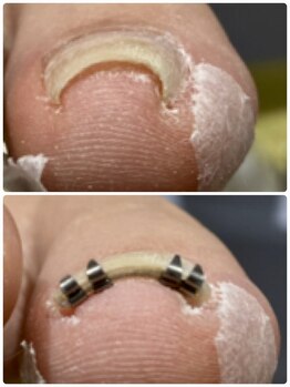 ナチュラル ウィズ(natural with)/巻き爪ケアもお任せください