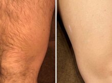 ウルル(Ululu)/【メンズ脱毛】11回目