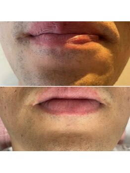 ランプシー(Lampsi)/青ヒゲ解消!美肌ヒゲ脱毛