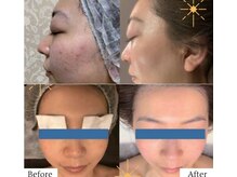 ウリア(ULIA)/がんこな大人ニキビケアに