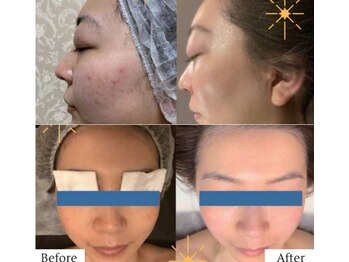 ウリア(ULIA)/がんこな大人ニキビケアに